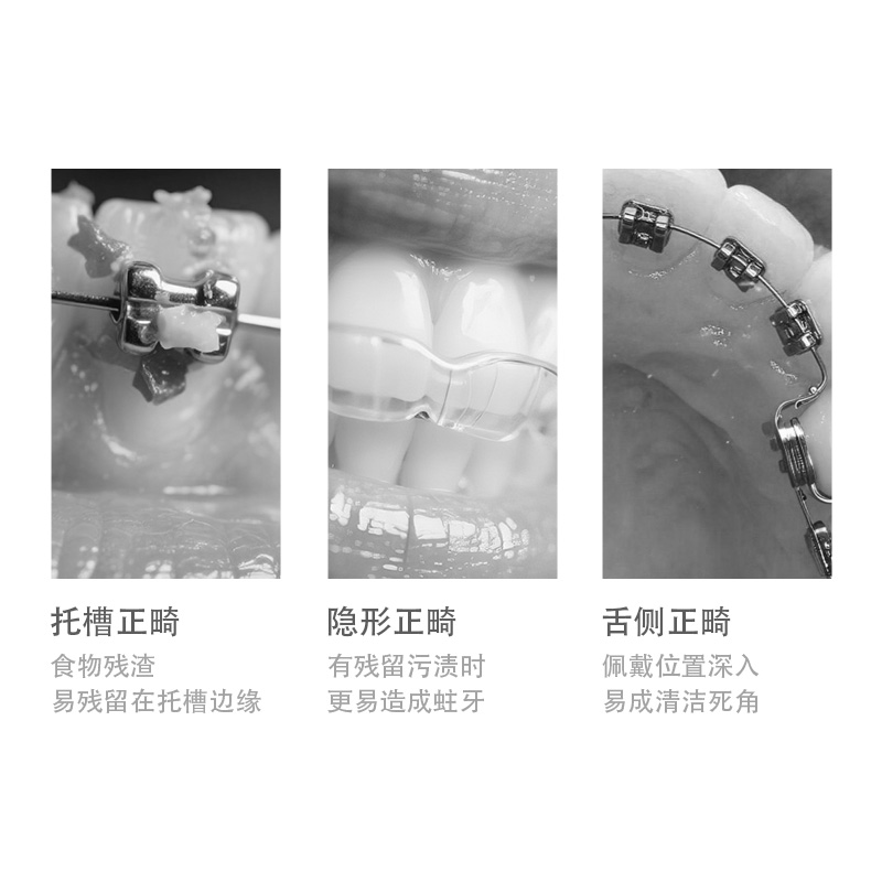 正畸难清洁